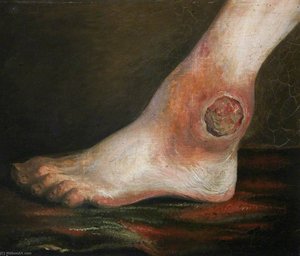 The Wounded following the Battle of Corunna Gunshot Wound of Ankle Joint